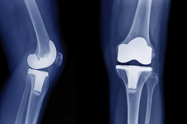 X-ray image of total knee arthroplasty / total knee replacement
