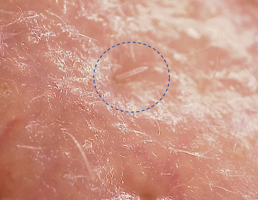 Demodex folliculorum mite