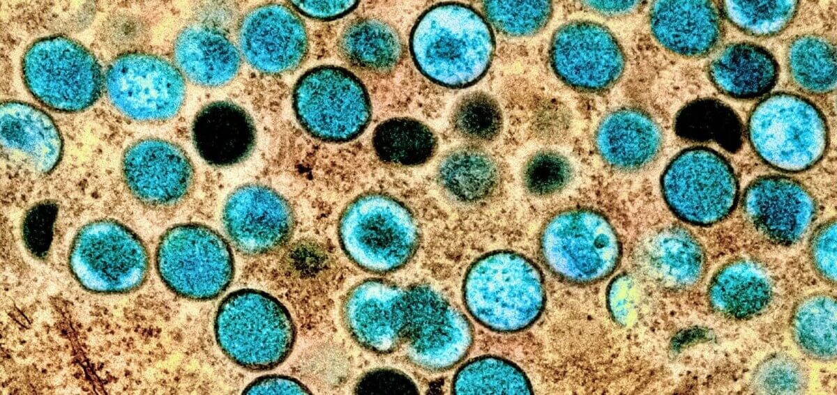 Monkeypox virus