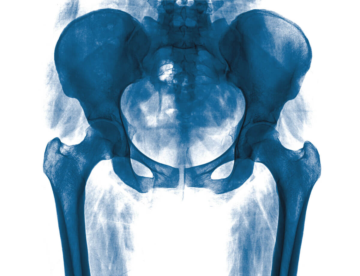 X-ray of the pelvis and spinal column of a woman
