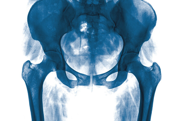 X-ray of the pelvis and spinal column of a woman