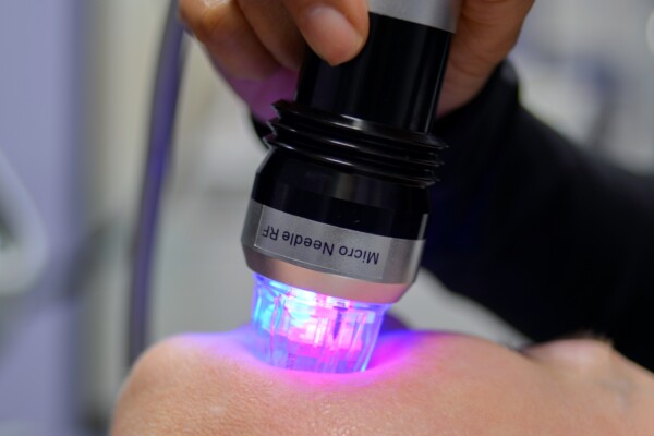Close-up of microneedling procedure on woman's cheek.