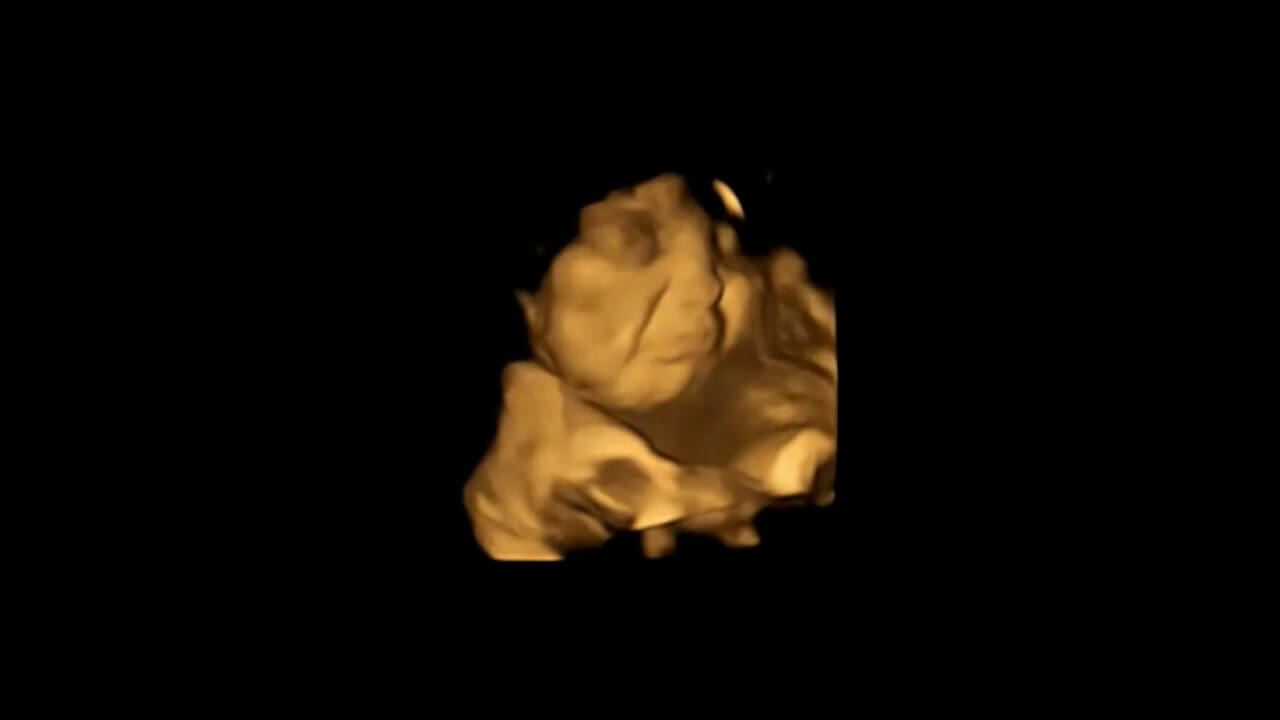 Fetus "scowls" at kale