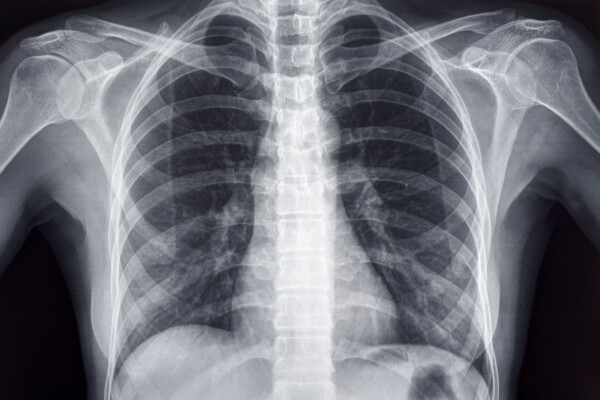 Chest x-ray of an adult female human