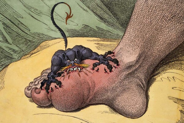 Have scientists found a new treatment for the ancient foot condition gout?