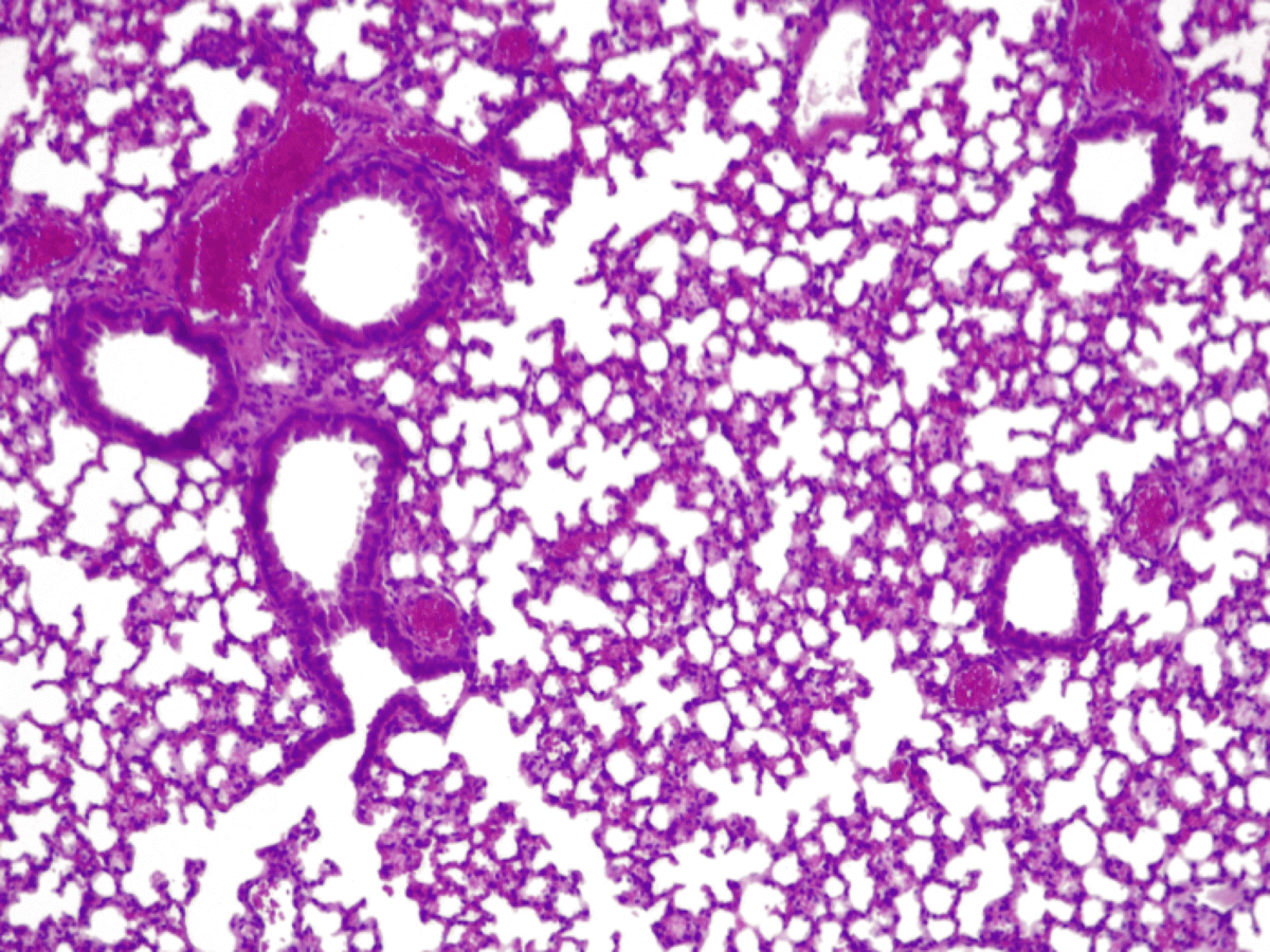 lung infection