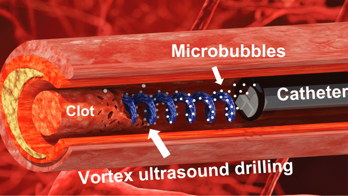 vortex ultrasound