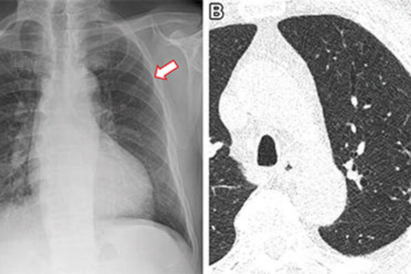 X-ray pictures of a person's lungs