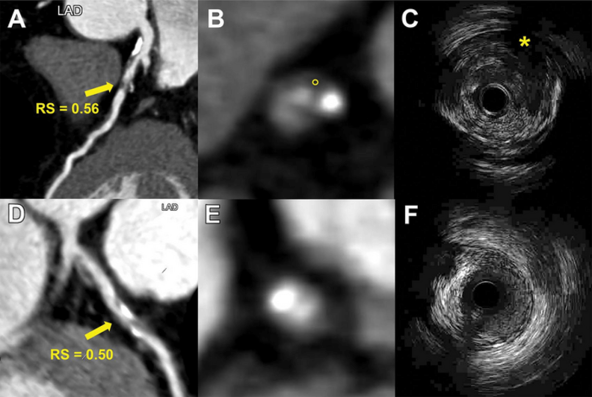 CT scans of the heart