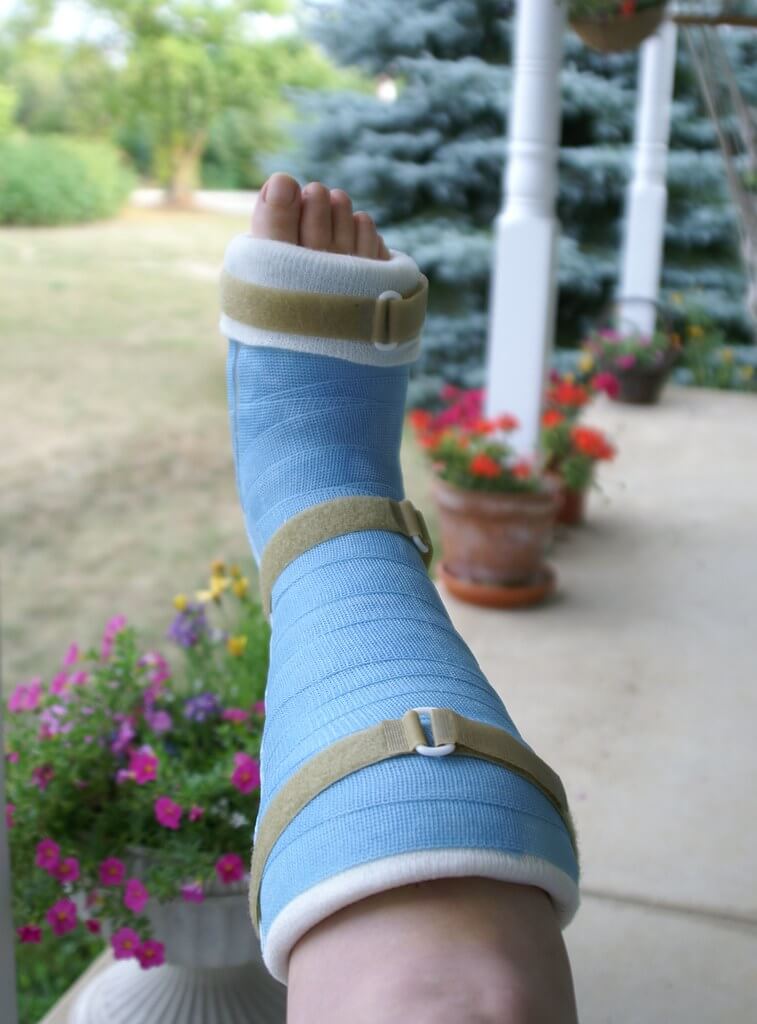 Cast on a person's leg