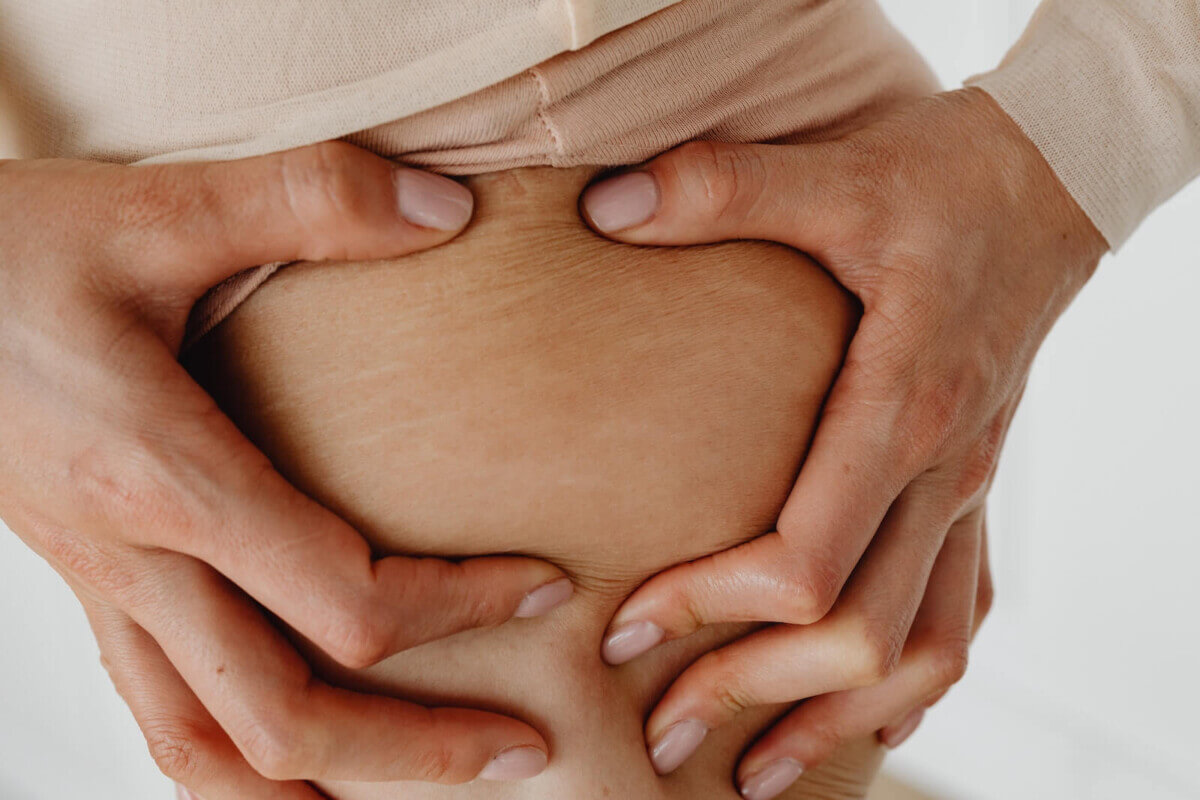 Someone showing their stretch marks on their thigh