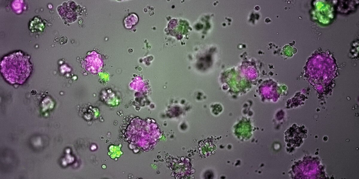 breast cancer tumors