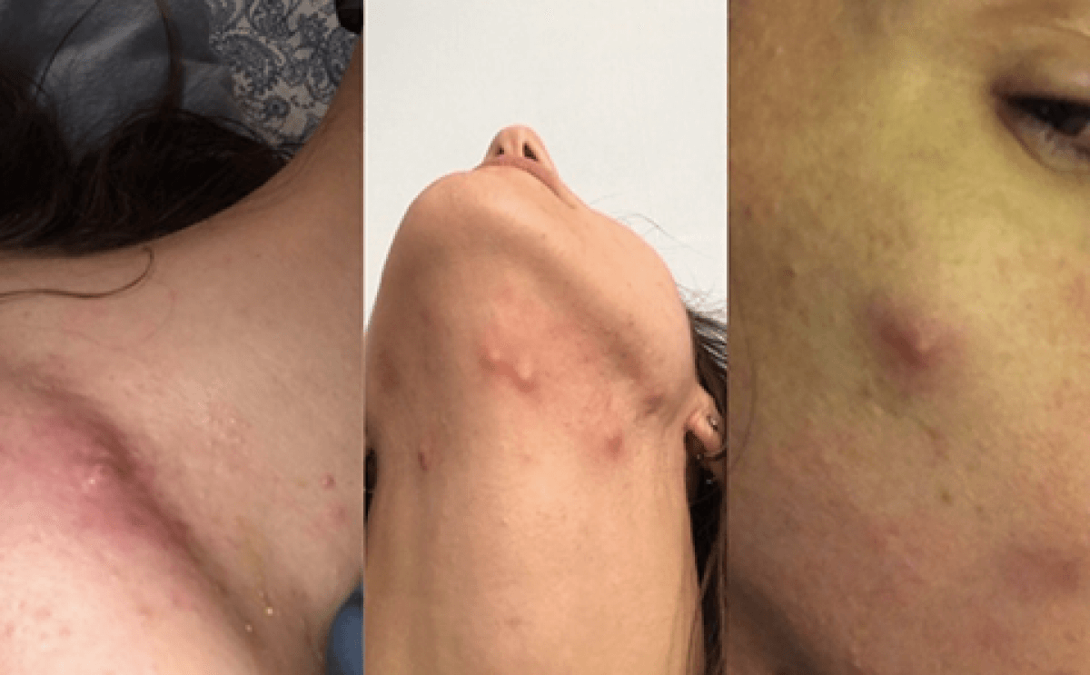 female acne patient