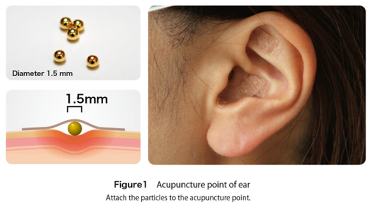ear beads to stimulate weight loss