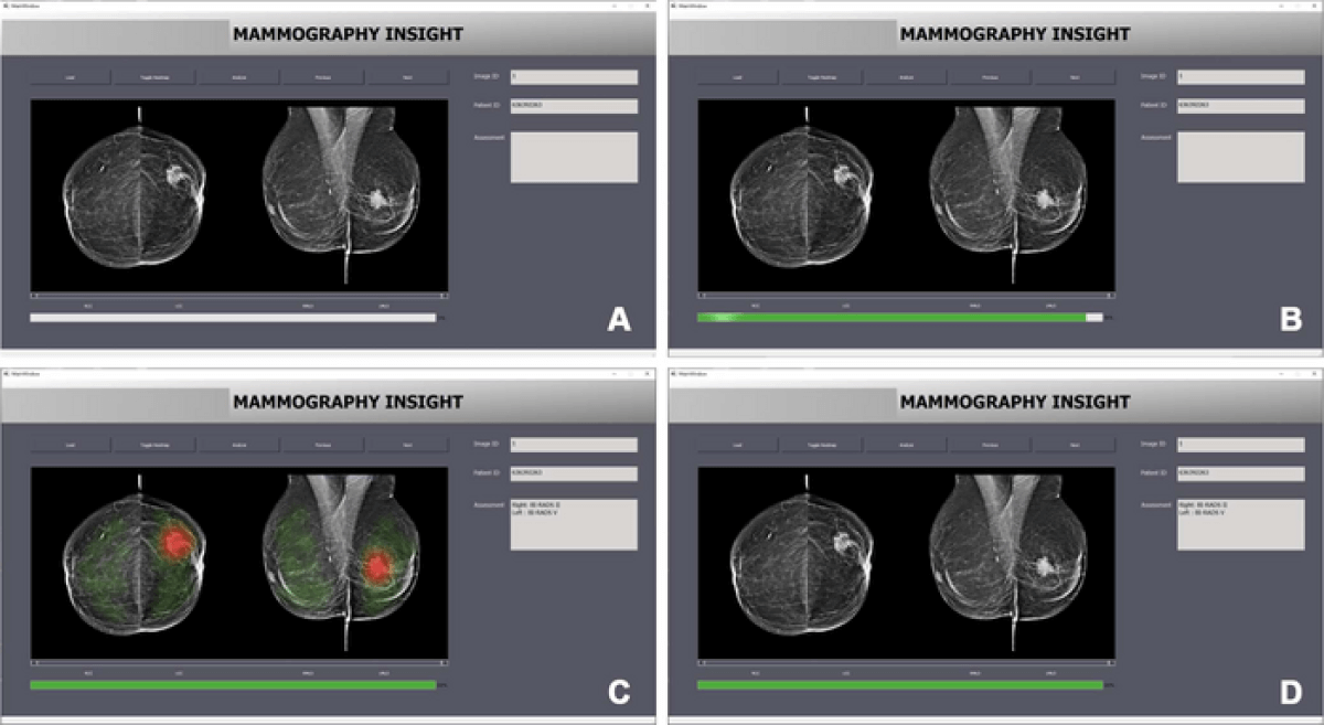 mammograms