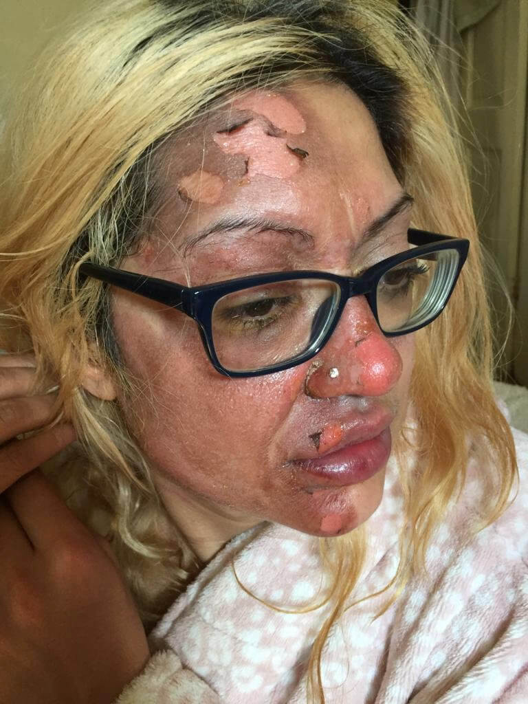 Shafia Bashir facial burns