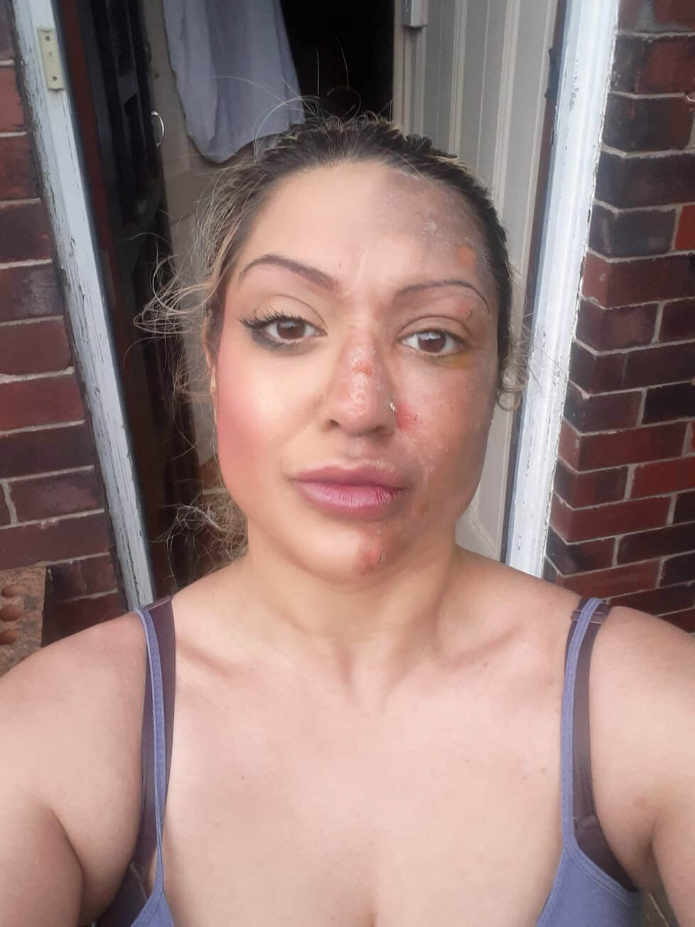 Shafia Bashir showing her egg burns.