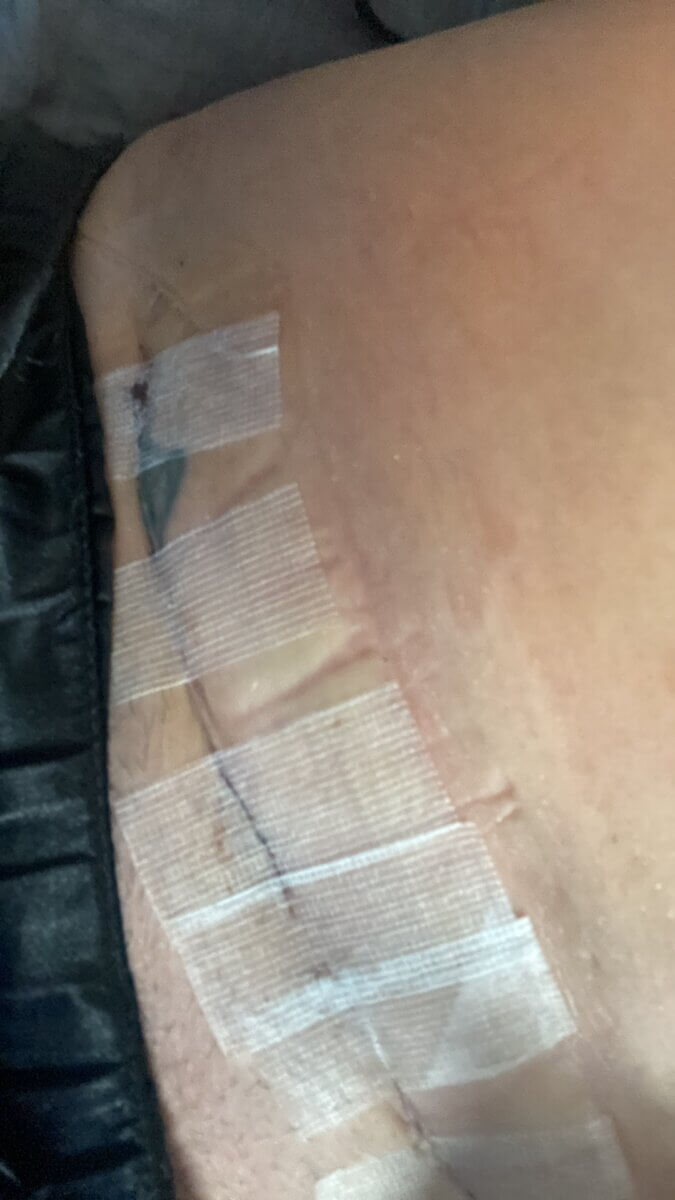 Sarah's scar after the operation on her unborn baby.