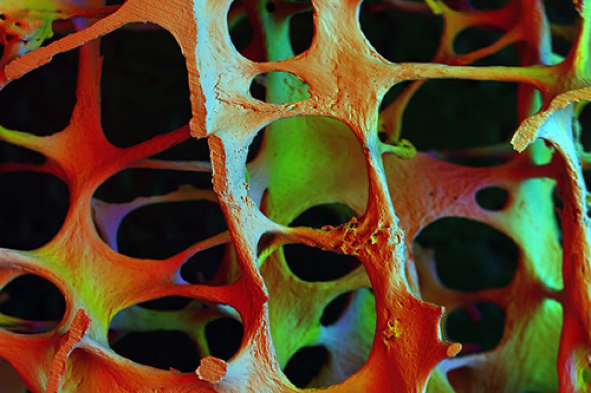 scan of osteoporotic bone