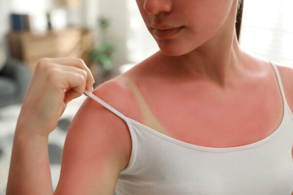 A woman with severe sunburn