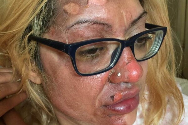 Shafia Bashir showing her egg burns after using a TikTok egg-cooking hack