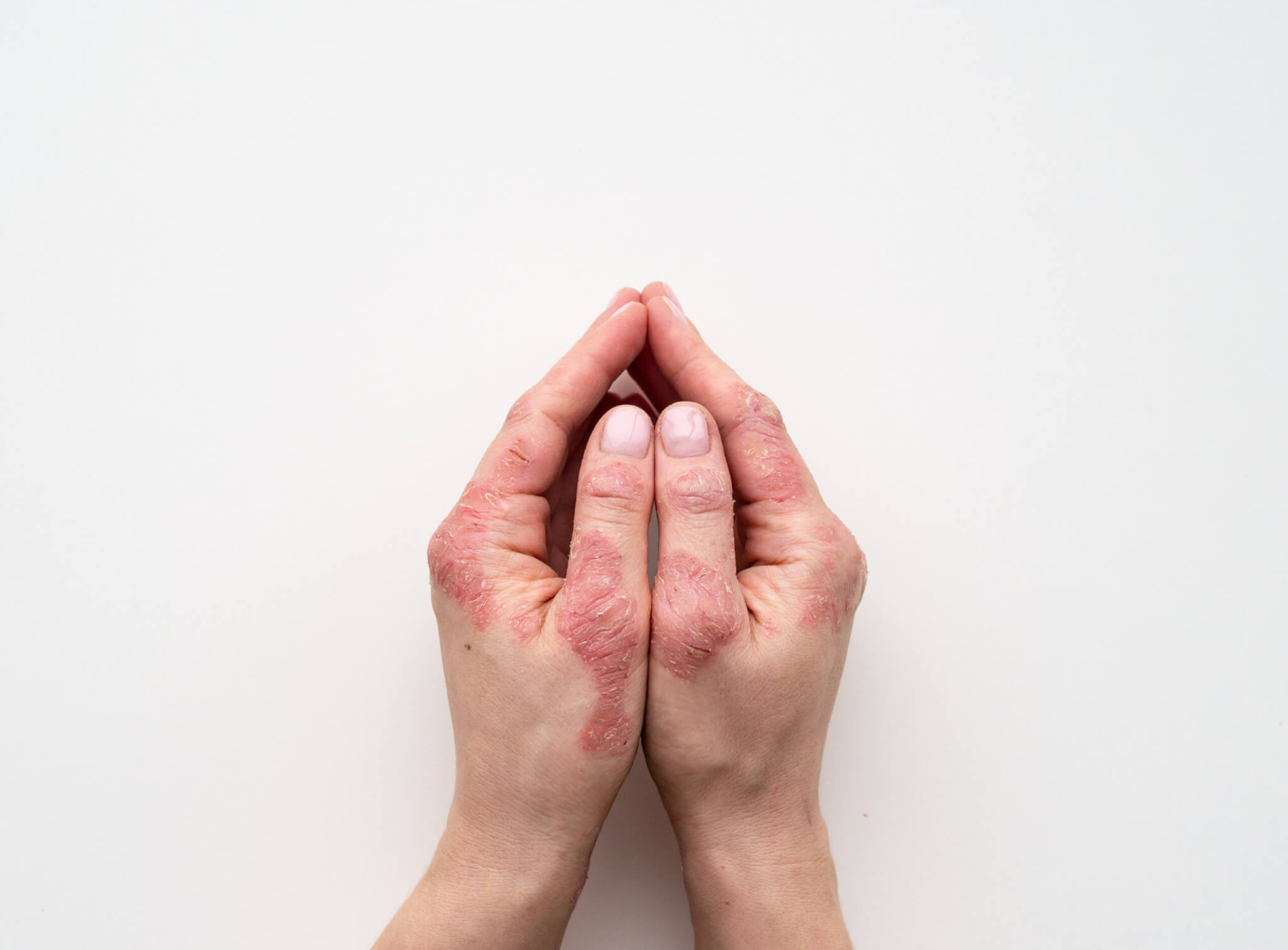Cracked, dry hands from psoriasis outbreak