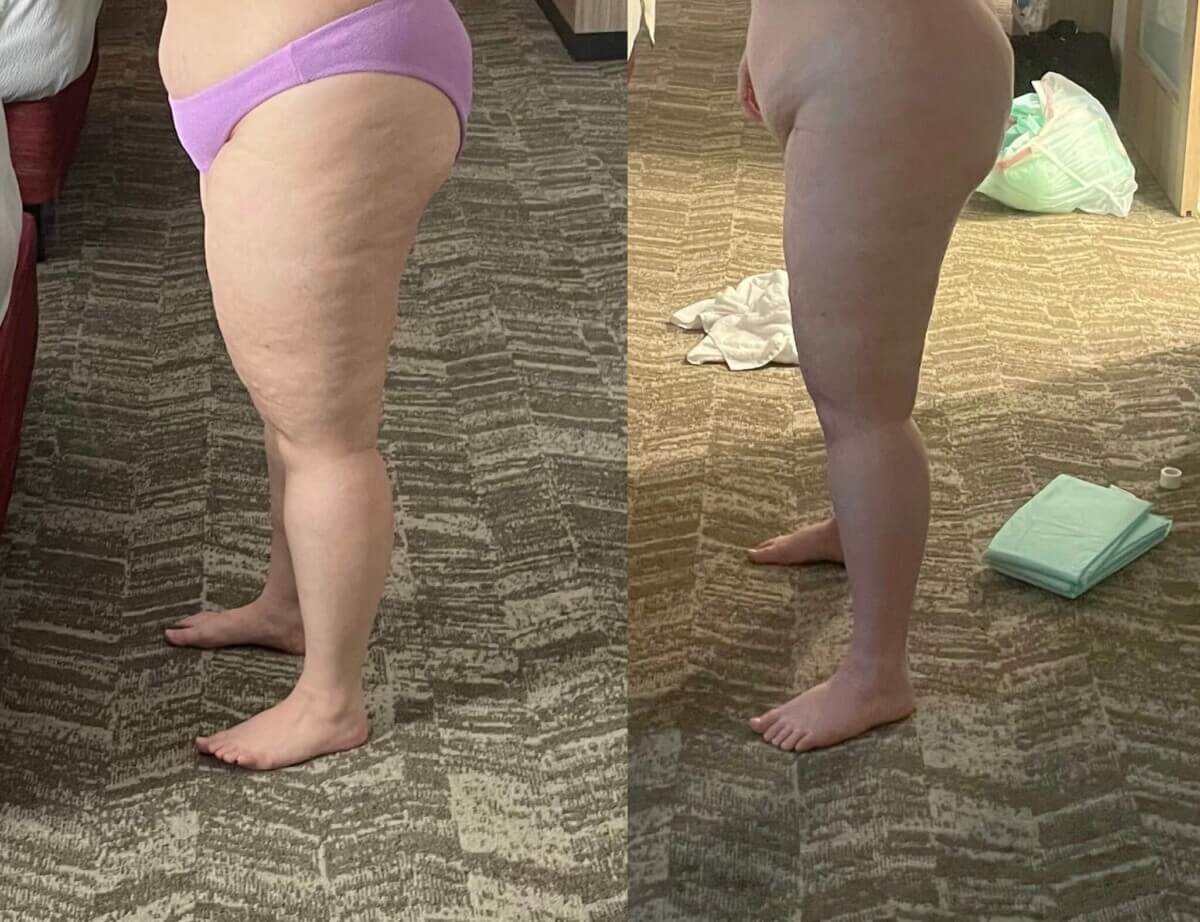 Alisa Vandercruyssen displays the change after draining over 6.5 liters of fluid from her legs.