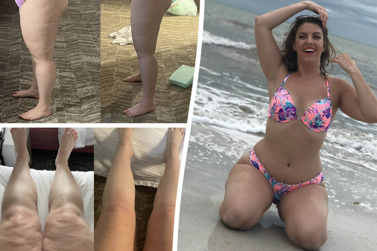 lipedema patient