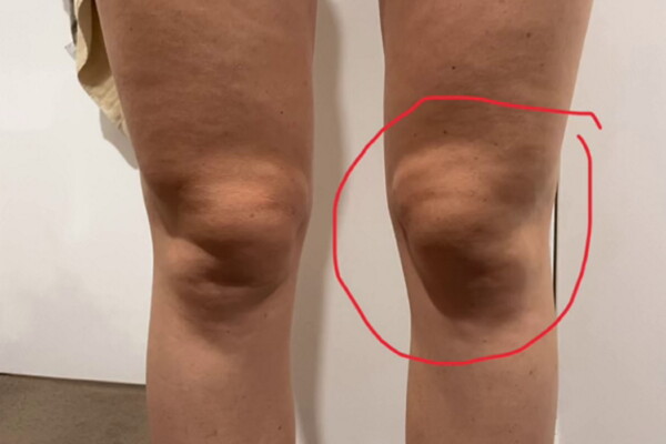 Amy Haigh's knees after having pain at the gym
