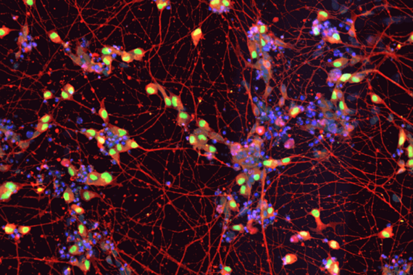 motor neurons in ALS patient