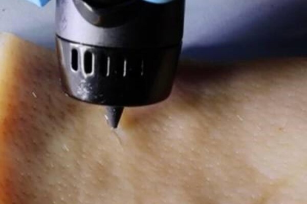 3d printing pen for healing skin