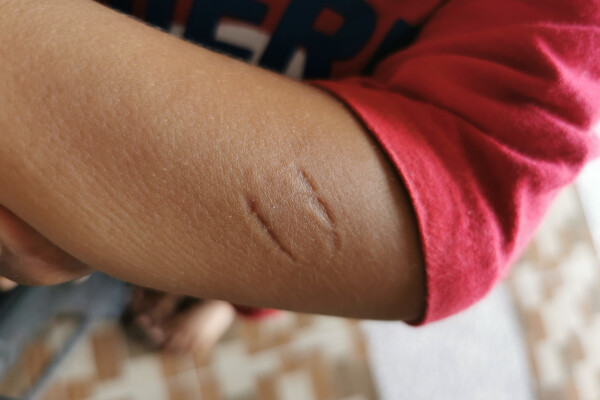 closeup photo of a bite mark
