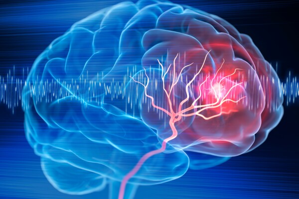 X-Ray illustration of brain stroke