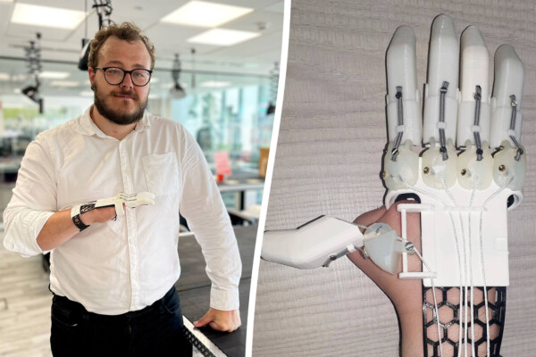 Luke Cox and his prosthetic hand