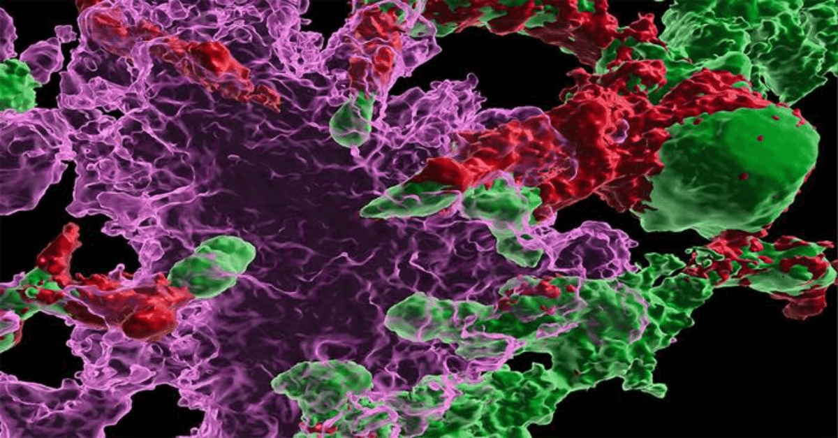Systemic transplantation of wild-type hematopoietic stem and progenitor cells (green) led to their differentiation into microglia-like cells (red), which reduced the amount of beta amyloid plaques (magenta) in the brain.