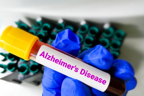 Alzheimer's Disease Blood Test