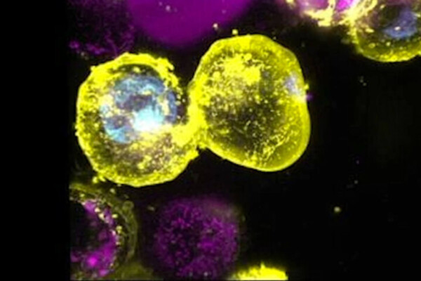 Researchers have found that a genetic change that increases the risk of inflammation, through a process described as ‘explosive’ cell death, is carried by up to 3% of the global population