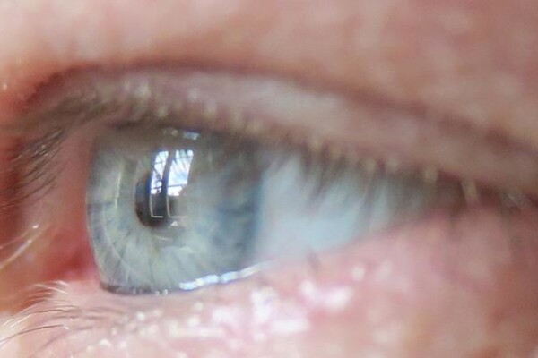 “The eye is our only window into the body, and it’s immune-privileged,” says Anna Herland, senior lecturer in the Division of Bionanotechnology at SciLifeLab at KTH Royal Institute of Technology, and the AIMES research center at KTH and Karolinska Institute