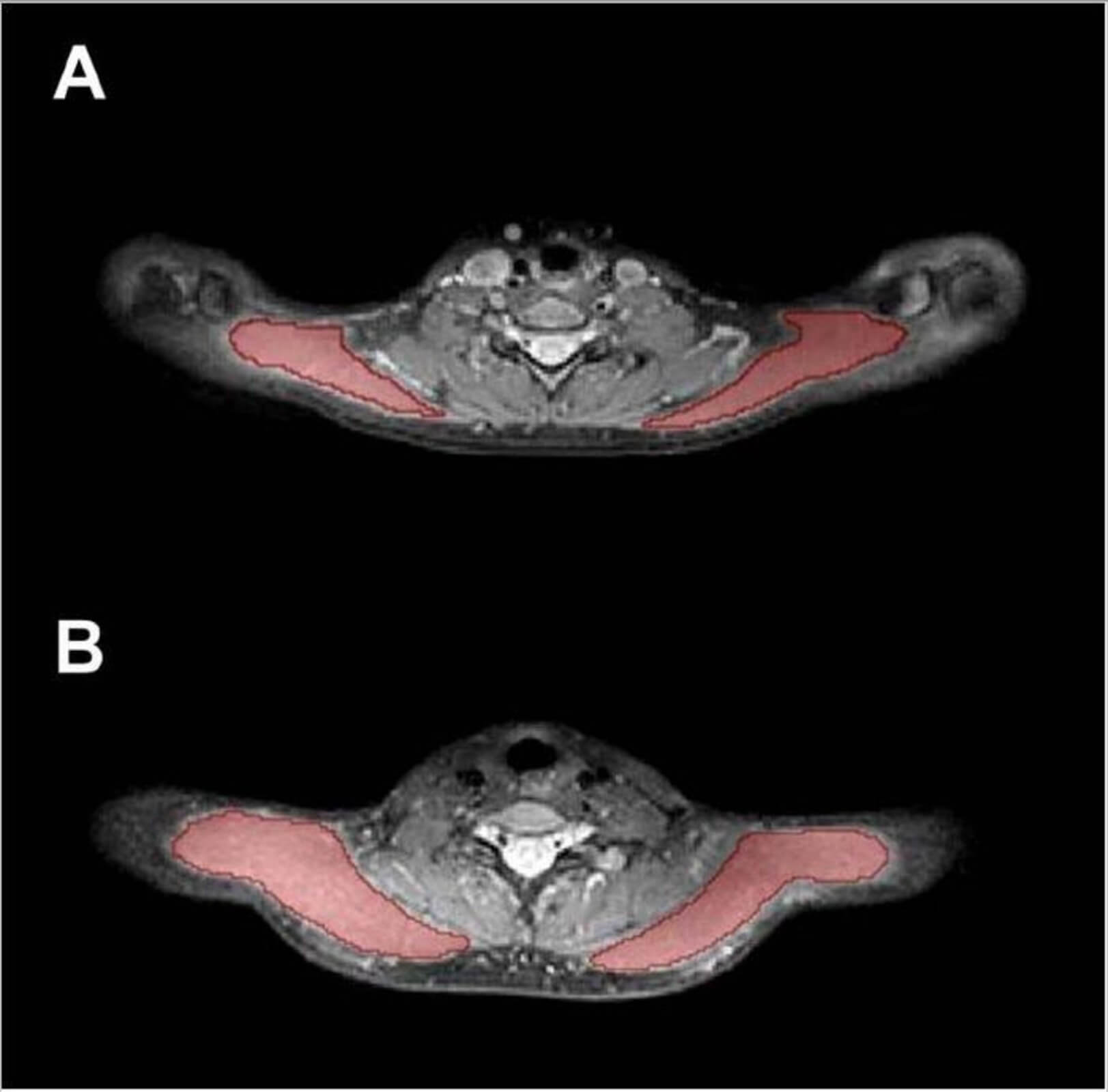 Exemplary cases for trapezius muscle segmentations