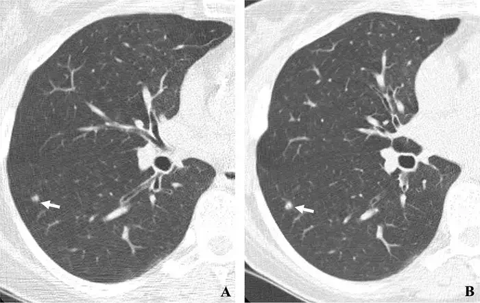lung cancer screening