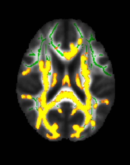 neuroinflammation of the brain