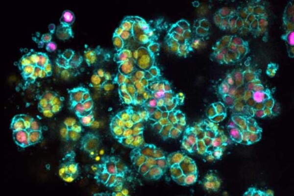 3D structures formed by human pancreatic cancer cells