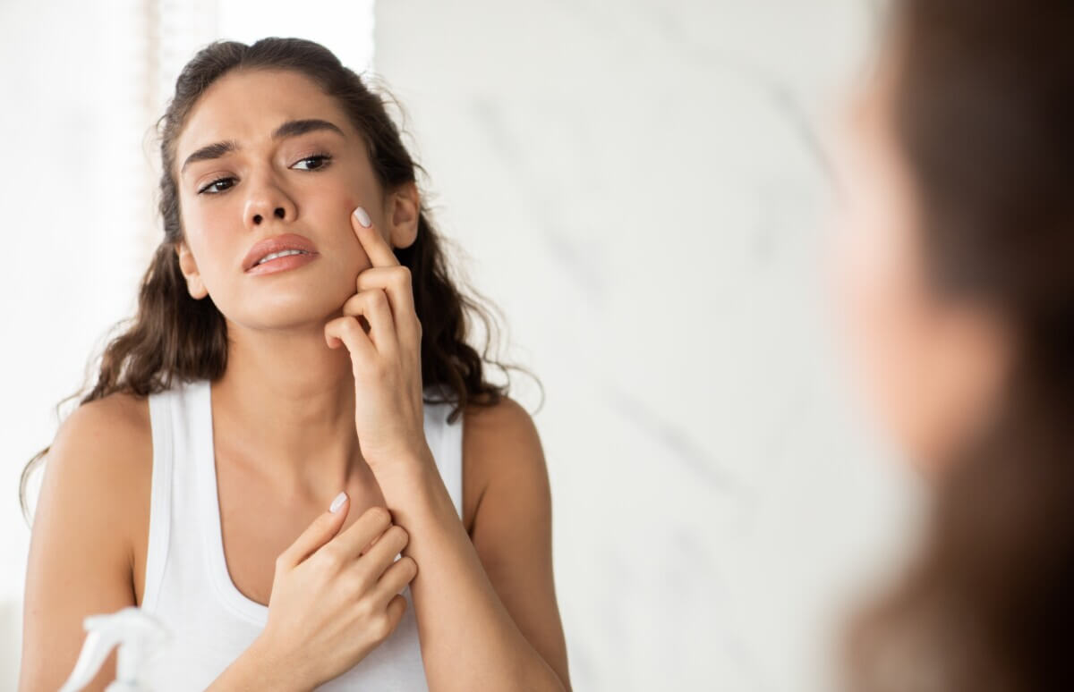 Woman with acne spots pimple on face