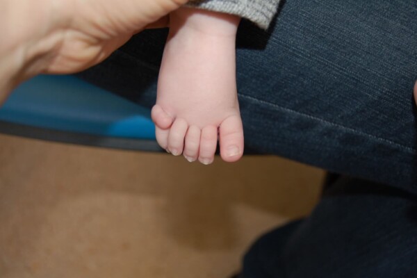 The foot of one of the children in the study, showing an extra toe