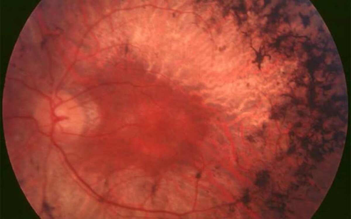 eye retinitis