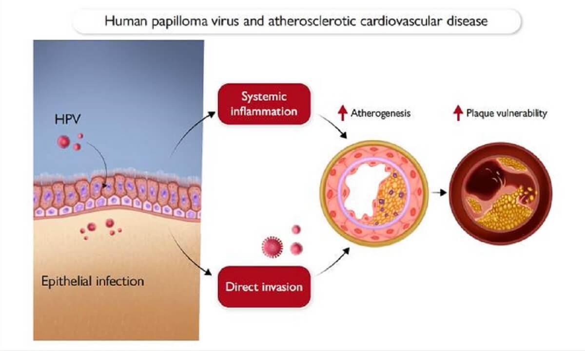 infographic on hpv and cardiovascular death