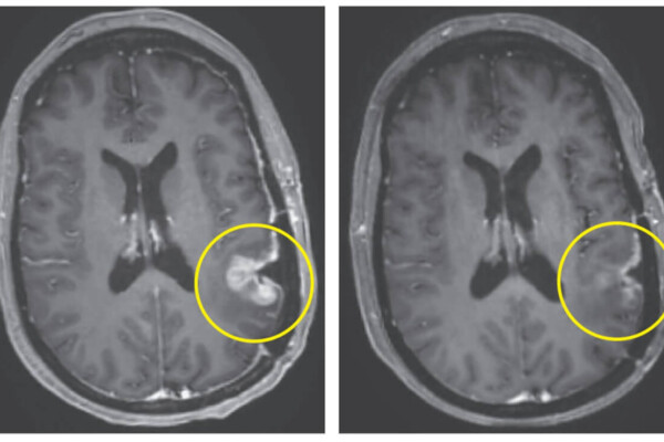 brain cancer tumor scan