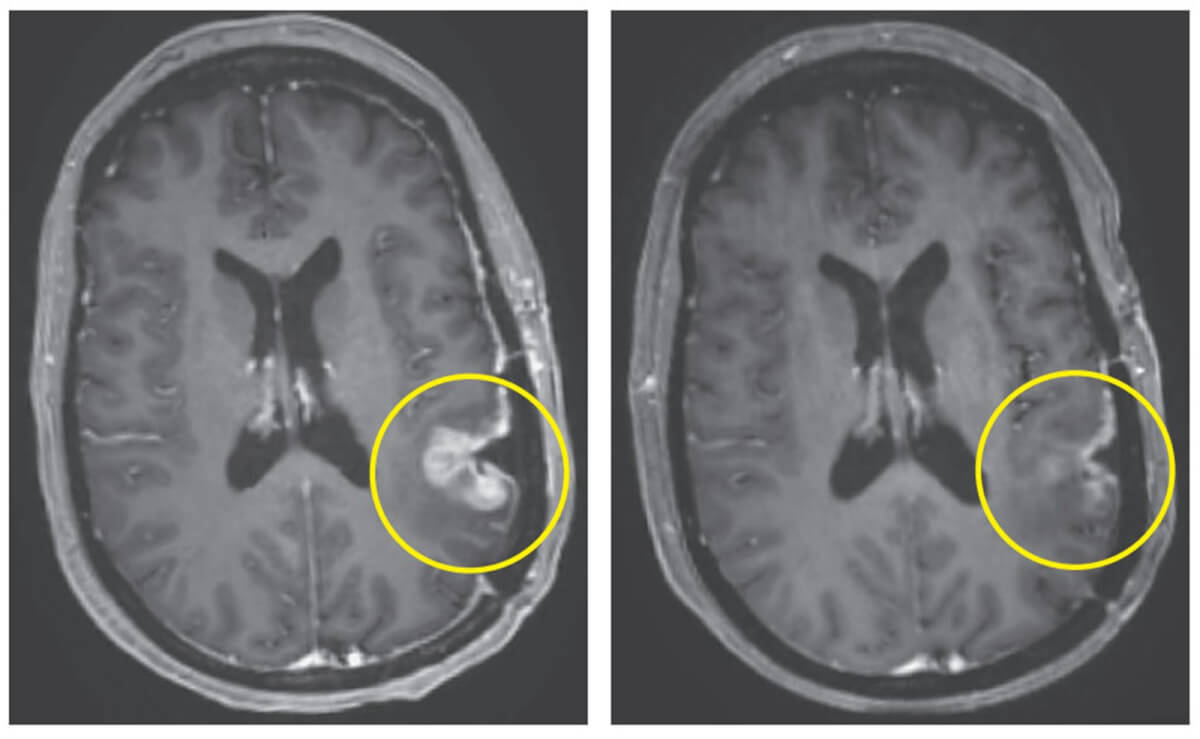 brain cancer tumor