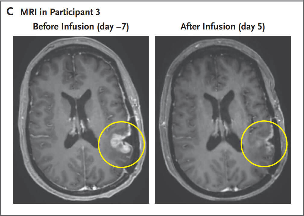 MRI results from Participant 3, before infusion (day -7) and after infusion (day 5) 