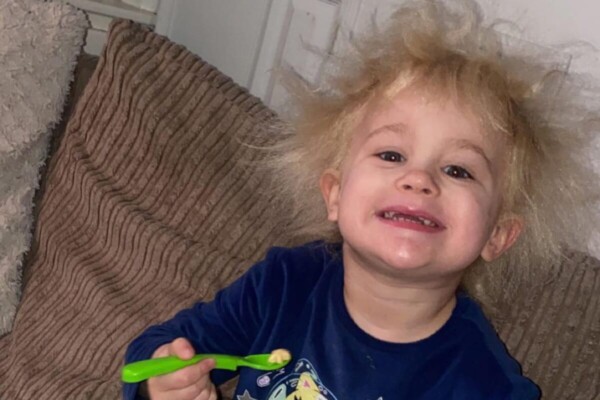Nellie Butler, two, is believed to have uncombable Hair Syndrome